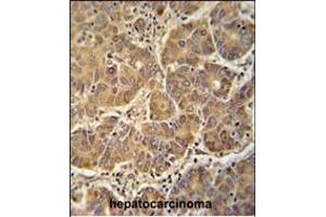 ATP5D antibody (N-term) (ABIN652148 and ABIN2840566) immunohistochemistry analysis in formalin fixed and paraffin embedded human hepatocarcinoma followed by peroxidase conjugation of the secondary antibody and DAB staining. (ATP5F1D 抗体  (N-Term))