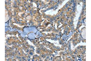 The image on the left is immunohistochemistry of paraffin-embedded Human thyroid cancer tissue using ABIN7128589(ATP4B Antibody) at dilution 1/40, on the right is treated with fusion protein. (ATP4b 抗体)