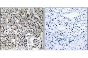Immunohistochemistry analysis of paraffin-embedded human breast carcinoma tissue, using USP19 Antibody. (USP19 抗体  (AA 391-440))