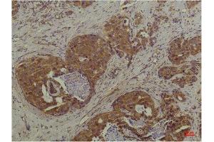 Immunohistochemistry (IHC) analysis of paraffin-embedded Human Breast Carcinoma using P44/42 MAPK (ERK1/2) Mouse Monoclonal Antibody diluted at 1:200. (ERK1/2 抗体)