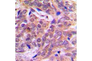 Immunohistochemical analysis of Beta-catenin (pS37) staining in human breast cancer formalin fixed paraffin embedded tissue section. (beta Catenin 抗体  (N-Term, pSer37))