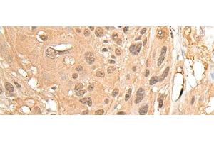 Immunohistochemistry of paraffin-embedded Human ovarian cancer tissue using MED23 Polyclonal Antibody at dilution of 1:30(x200) (MED23 抗体)