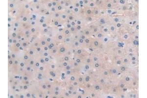 Detection of TLR3 in Human Liver cancer Tissue using Polyclonal Antibody to Toll Like Receptor 3 (TLR3) (TLR3 抗体  (AA 404-532))