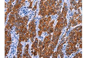The image on the left is immunohistochemistry of paraffin-embedded Human gastic cancer tissue using ABIN7130460(NR4A2 Antibody) at dilution 1/20, on the right is treated with fusion protein. (NR4A2 抗体)