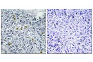 Immunohistochemistry analysis of paraffin-embedded human breast carcinoma tissue using TOP2A (Phospho-Ser1106) antibody. (Topoisomerase II alpha 抗体  (pSer1106))
