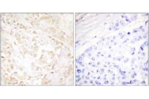Immunohistochemistry analysis of paraffin-embedded human breast carcinoma tissue, using XRCC6 Antibody. (RCC6 (AA 554-603) 抗体)
