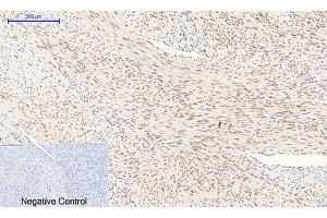 Immunohistochemical analysis of paraffin-embedded human uterus cancer tissue. (MAPK14 抗体  (pThr180))