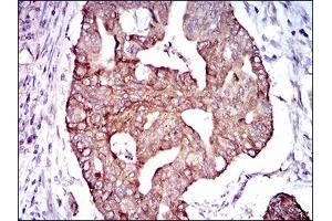 Immunohistochemical analysis of paraffin-embedded rectum cancer tissues using PDE1B mouse mAb with DAB staining. (PDE1B 抗体  (AA 370-536))