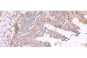 Immunohistochemistry of paraffin-embedded Human colorectal cancer tissue using ZSWIM1 Polyclonal Antibody at dilution of 1:55(x200) (ZSWIM1 抗体)