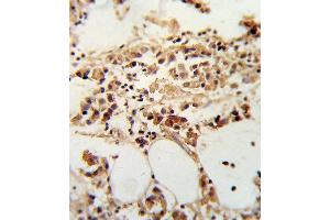Formalin-fixed and paraffin-embedded human breast carcinoma reacted with TI Antibody (Center), which was peroxidase-conjugated to the secondary antibody, followed by DAB staining. (TIMP3 抗体  (AA 113-139))