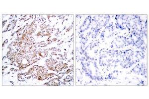 Immunohistochemical analysis of paraffin-embedded human breast carcinoma tissue using Myc (phospho-Thr58) antibody (E011034). (c-MYC 抗体  (pThr58))