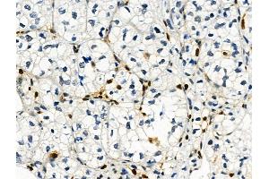 Phospho-Histone H3 (Ser28) Antibody at 1/100 staining Human kidney cancer by IHC-P. (Histone 3 抗体  (H3S28ph))