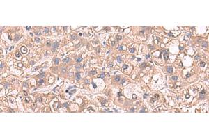 Immunohistochemistry of paraffin-embedded Human liver cancer tissue using SARS Polyclonal Antibody at dilution of 1:65(x200) (Seryl-tRNA Synthetase (SARS) 抗体)