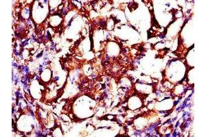 Immunohistochemistry of paraffin-embedded human gastric cancer using ABIN7146178 at dilution of 1:100 (ZMPSTE24 抗体  (AA 217-347))