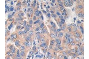 Detection of AKAP11 in Human Breast cancer Tissue using Polyclonal Antibody to A Kinase Anchor Protein 11 (AKAP11)