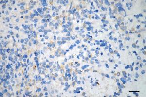 Immunohistochemistry was performed on paraffin-embedded human glioblastoma using CDC42BPA antibody (ABIN7797991), 1:200).