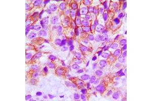 Immunohistochemistry (IHC) image for anti-Cadherin 1, Type 1, E-Cadherin (Epithelial) (CDH1) (N-Term) antibody (ABIN7295212)