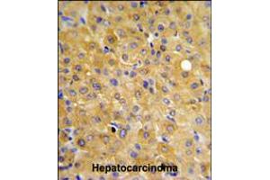 DLG7 Antibody IHC analysis in formalin fixed and paraffin embedded hepatocarcinoma followed by peroxidase conjugation of the secondary antibody and DAB staining. (DLGAP5 抗体  (AA 228-258))