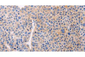 Immunohistochemistry of paraffin-embedded Human liver cancer using ADCY1 Polyclonal Antibody at dilution of 1:60 (ADCY1 抗体)