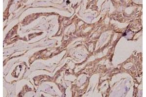 Immunohistochemical analysis of paraffin-embedded human breast cancer tissue using IgG1 polyclonal antibody . (兔 anti-人 IgG1 (AA 211-260) Antibody)