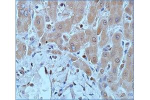 Immunohistochemical staining (Formalin-fixed paraffin-embedded sections) of human hepatocellular carcinoma with DNMT1 monoclonal antibody, clone 60B1220.
