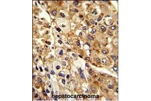 Formalin-fixed and paraffin-embedded human hepatocarcinoma reacted with ATP1B2 Antibody (Center), which was peroxidase-conjugated to the secondary antibody, followed by DAB staining. (ATP1B2 抗体  (AA 115-141))