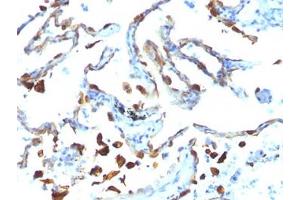FFPE human lung carcinoma tested with MFGE8 antibody (MFG-06)