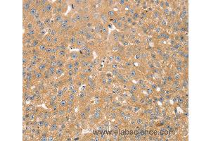 Immunohistochemistry of Human breast cancer using SNX2 Polyclonal Antibody at dilution of 1:40 (Sorting Nexin 2 抗体)