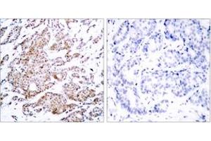 Immunohistochemistry analysis of paraffin-embedded human breast carcinoma, using Myc (Phospho-Thr58) Antibody. (c-MYC 抗体  (pThr58))