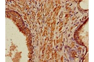Immunohistochemistry of paraffin-embedded human prostate cancer using ABIN7165984 at dilution of 1:100 (PIH1D3 抗体  (AA 1-214))