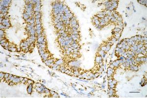 Immunohistochemistry was performed on paraffin-embedded human ovarian carcinoma using hsp60 antibody (ABIN7798847), 1:200).