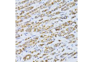 Immunohistochemistry of paraffin-embedded human colon carcinoma using CCDC92 antibody (ABIN5974817) at dilution of 1/100 (40x lens). (CCDC92 抗体)