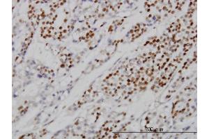 Immunoperoxidase of monoclonal antibody to MCM7 on formalin-fixed paraffin-embedded human ovary, clear cell carcinoma. (MCM7 抗体  (AA 1-389))