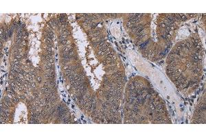 Immunohistochemistry of paraffin-embedded Human colon cancer using CUL3 Polyclonal Antibody at dilution of 1:30 (Cullin 3 抗体)