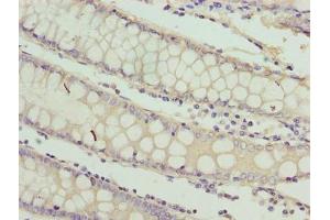 Immunohistochemistry of paraffin-embedded human colon cancer using ABIN7167326 at dilution of 1:100 (RAB3B 抗体  (AA 1-219))