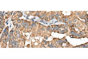 Immunohistochemistry of paraffin-embedded Human thyroid cancer tissue using BLNK Polyclonal Antibody at dilution of 1:40(x200) (B-Cell Linker 抗体)