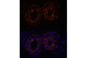 Immunofluorescence analysis of Human mammary cancer cells using TNF-α antibody (ABIN3020862, ABIN3020863, ABIN3020864, ABIN1513617 and ABIN6213762) at dilution of 1:100. (TNF alpha 抗体  (AA 1-233))