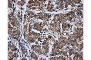 Immunohistochemical staining of paraffin-embedded Carcinoma of liver tissue using anti-KIAA1609 mouse monoclonal antibody. (KIAA1609 抗体)