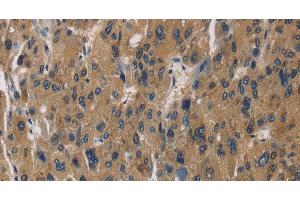 Immunohistochemistry of paraffin-embedded Human liver cancer using RAGE Polyclonal Antibody at dilution of 1:70 (RAGE 抗体)