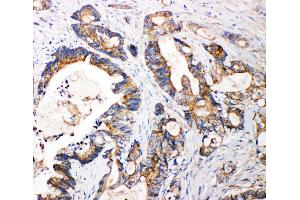 Anti-FGFR3 antibody, IHC(P) IHC(P): Human Intestinal Cancer Tissue (FGFR3 抗体  (N-Term))