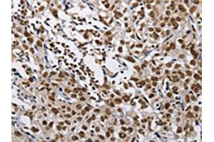 The image on the left is immunohistochemistry of paraffin-embedded Human esophagus cancer tissue using ABIN7128978(CMTM2 Antibody) at dilution 1/60, on the right is treated with fusion protein. (CMTM2 抗体)