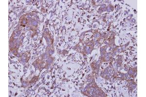 IHC-P Image Immunohistochemical analysis of paraffin-embedded human breast cancer, using TLR5, antibody at 1:250 dilution. (TLR5 抗体  (N-Term))