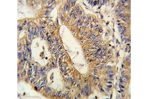 IHC analysis of FFPE human colon carcinoma stained with IL17RB antibody (IL17 Receptor B 抗体  (AA 207-234))
