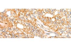 Immunohistochemistry of paraffin-embedded Human gastric cancer tissue using CHCHD3 Polyclonal Antibody at dilution of 1:45(x200) (CHCHD3 抗体)