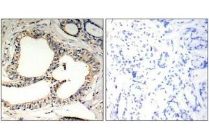 Immunohistochemical analysis of paraffin-embedded human breast carcinoma tissue using IkB-e(Phospho-Ser22) Antibody(left) or the same antibody preincubated with blocking peptide(right).