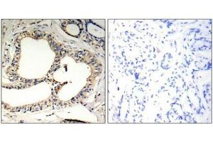 Immunohistochemical analysis of paraffin-embedded human breast carcinoma tissue using IkB-e(Phospho-Ser22) Antibody(left) or the same antibody preincubated with blocking peptide(right). (NFKBIE 抗体  (pSer22))