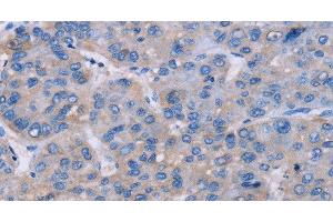 Immunohistochemistry of paraffin-embedded Human liver cancer tissue using NR1D1 Polyclonal Antibody at dilution 1:60 (NR1D1 抗体)