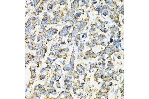 Immunohistochemistry of paraffin-embedded human lung cancer using ADSS antibody (ABIN6131467, ABIN6136604, ABIN6136606 and ABIN6216015) at dilution of 1:100 (40x lens). (ADSS 抗体  (AA 1-280))