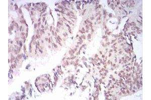 Immunohistochemical analysis of paraffin-embedded rectum cancer tissues using AOF1 mouse mAb with DAB staining.