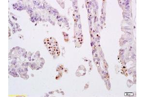 Formalin-fixed and paraffin embedded human breast carcinoma labeled with Anti-phospho-STAT3 (Tyr705) Polyclonal Antibody, Unconjugated (ABIN732638) at 1:200 followed by conjugation to the secondary antibody and DAB staining. (STAT3 抗体  (pTyr705))